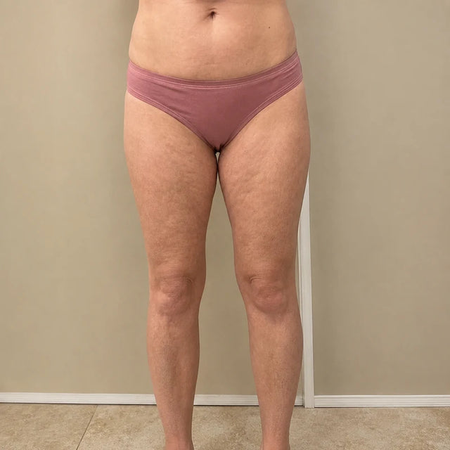 Day 15, thigh, after