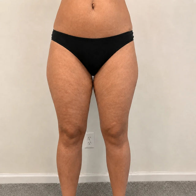 Day 15, thighs, after